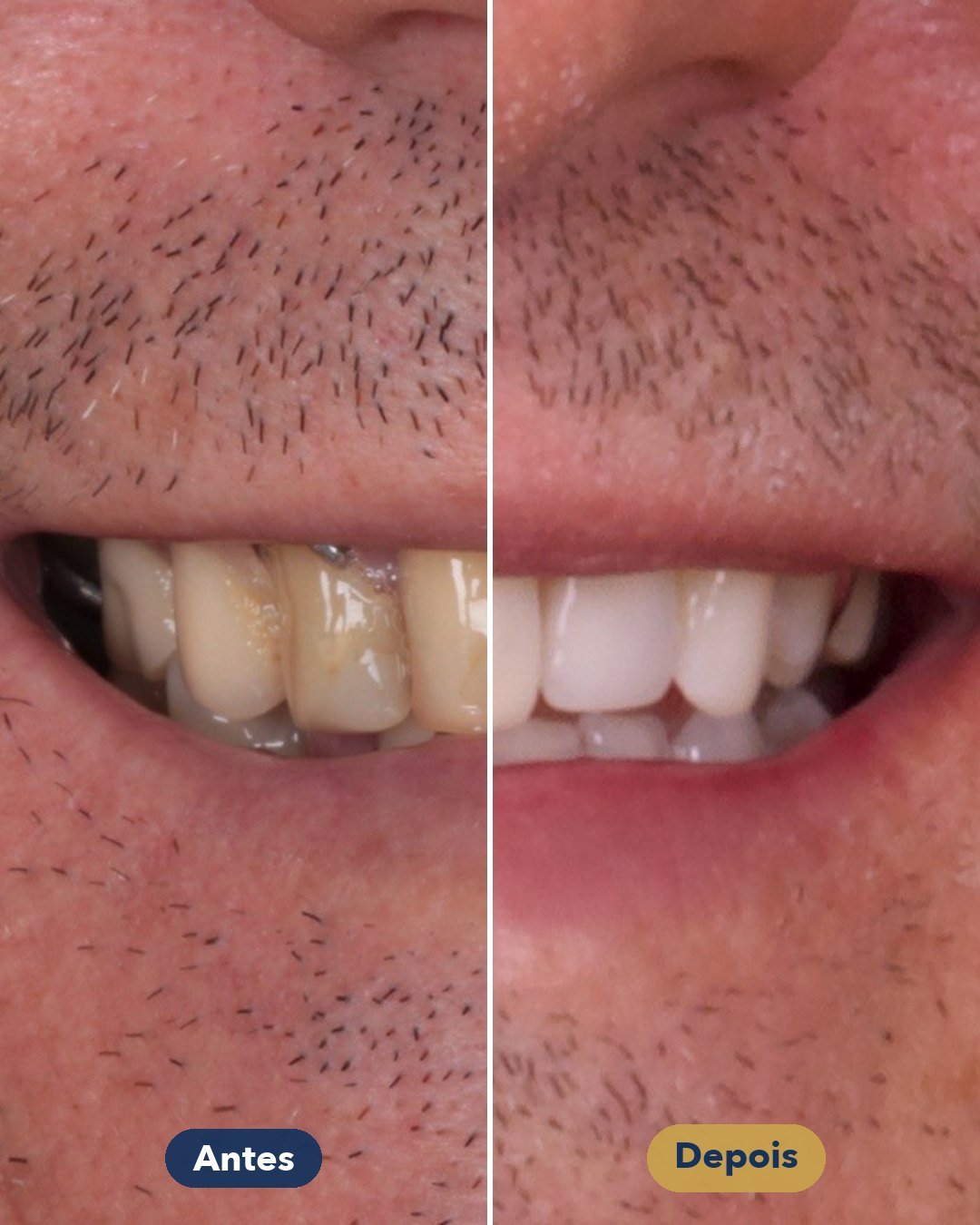 Resultado de Facetas em resina — antes e depois de paciente da Oral Feira