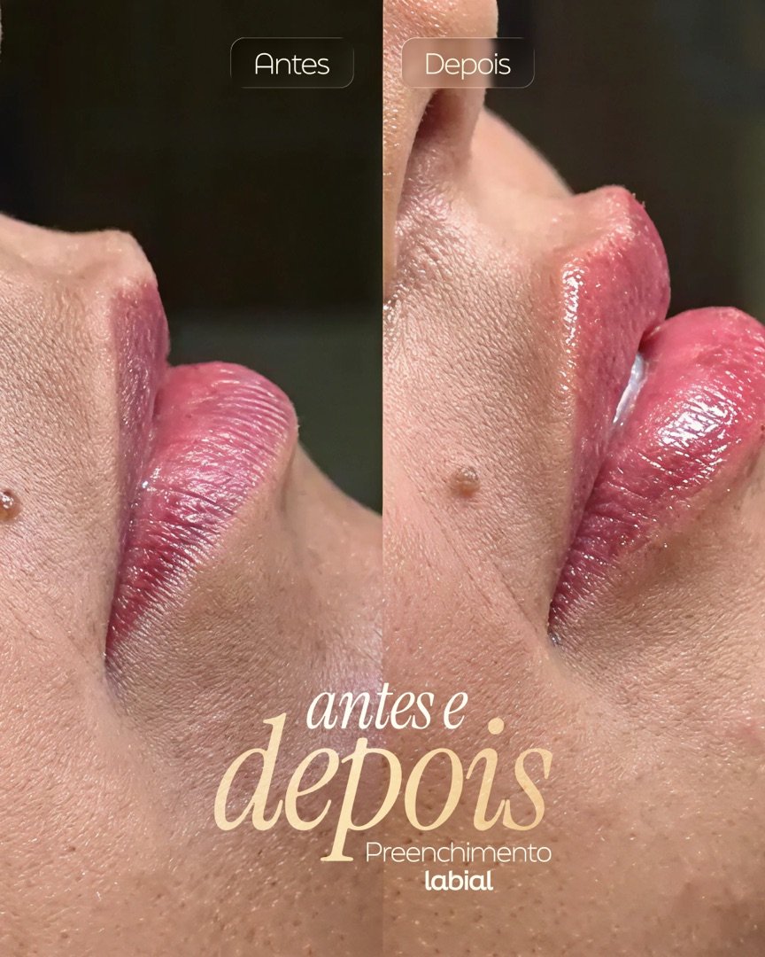 Resultado de Preenchimento labial — antes e depois de paciente da Oral Feira