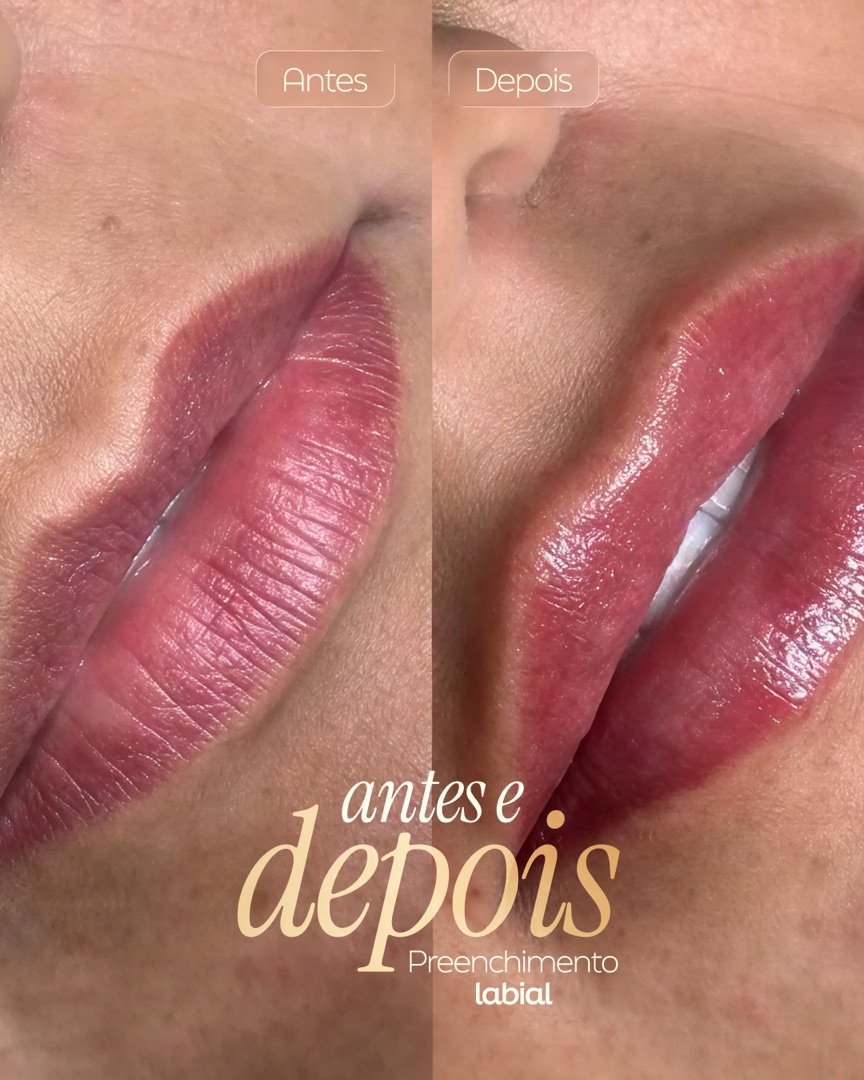 Resultado de Preenchimento labial — antes e depois de paciente da Oral Feira