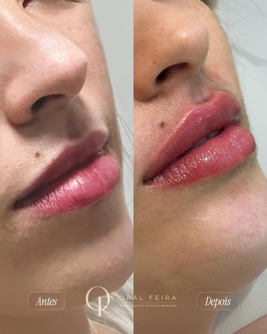 Resultado de Preenchimento labial — antes e depois de paciente da Oral Feira