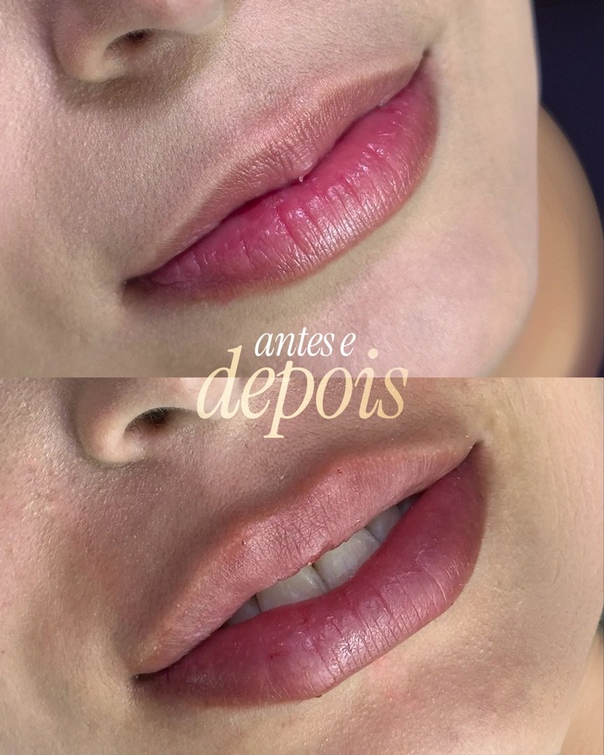 Resultado de Preenchimento labial — antes e depois de paciente da Oral Feira