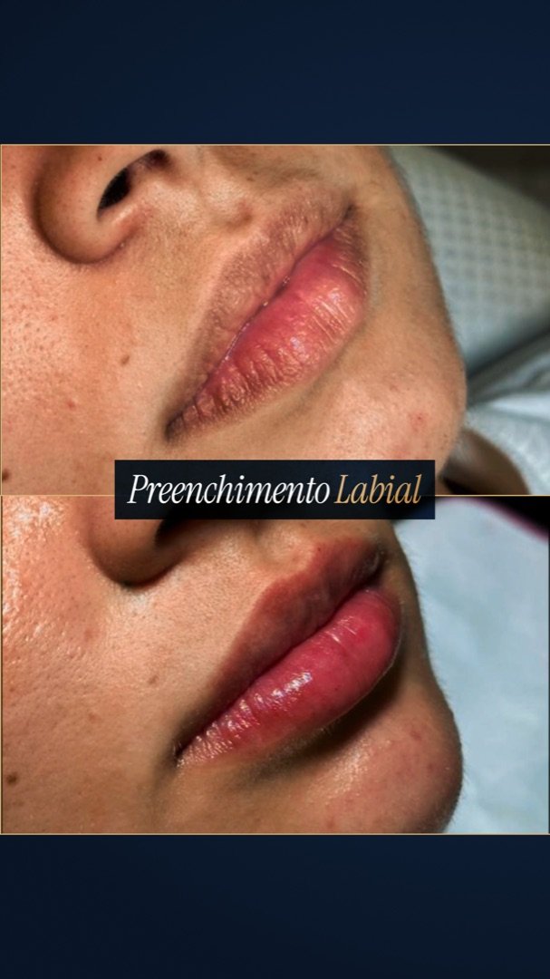 Resultado de Preenchimento labial — antes e depois de paciente da Oral Feira