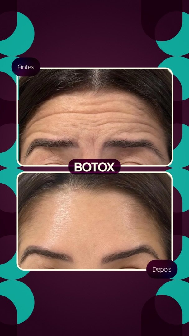 Resultado de Toxina botulínica — antes e depois de paciente da Oral Feira