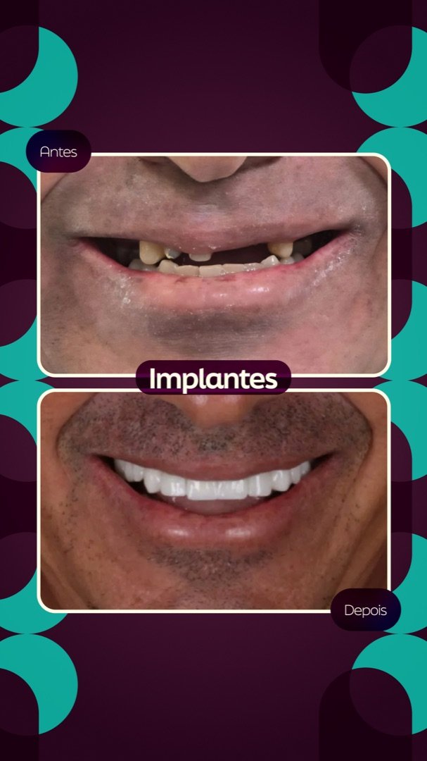 Resultado de Implante dentário — antes e depois de paciente da Oral Feira