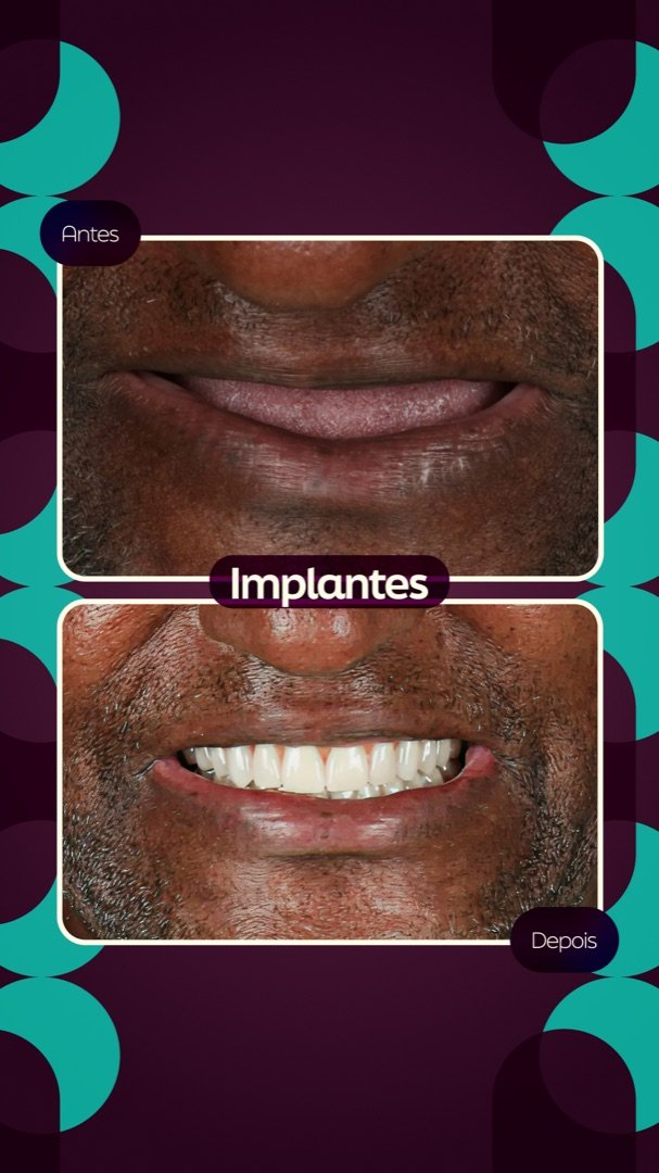Resultado de Implante dentário — antes e depois de paciente da Oral Feira