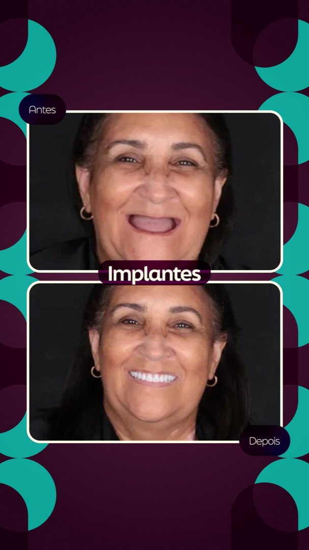 Resultado de Reabilitação com implantes — antes e depois de paciente da Oral Feira