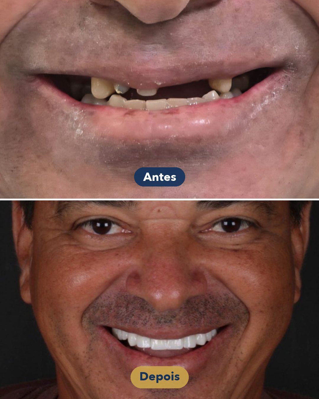 Resultado de Reabilitação com implantes — antes e depois de paciente da Oral Feira