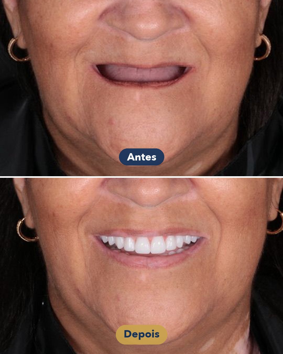 Resultado de Protocolo sobre implantes — antes e depois de paciente da Oral Feira