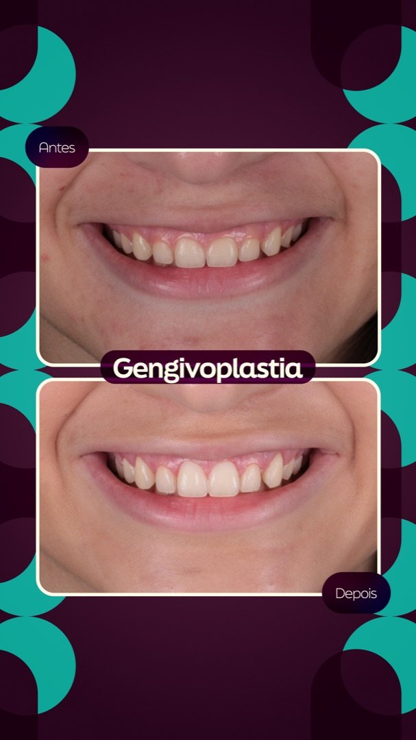 Resultado de Gengivoplastia — antes e depois de paciente da Oral Feira