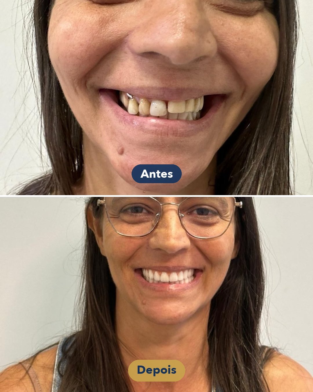 Resultado de Reabilitação do sorriso — antes e depois de paciente da Oral Feira