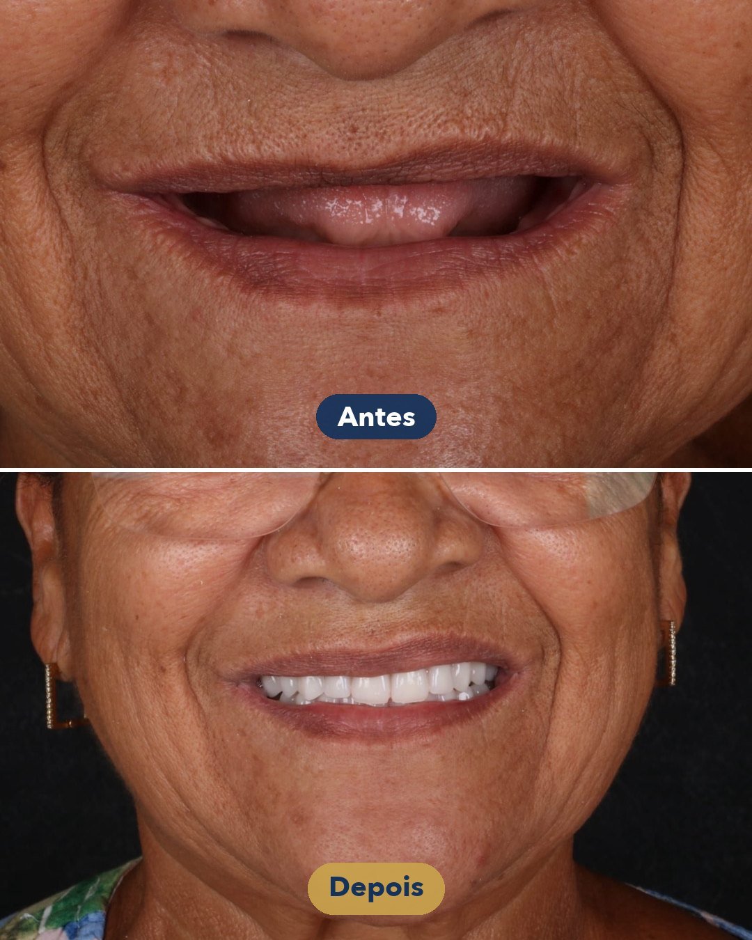 Resultado de Prótese total — antes e depois de paciente da Oral Feira